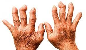 artritis reumatoide 