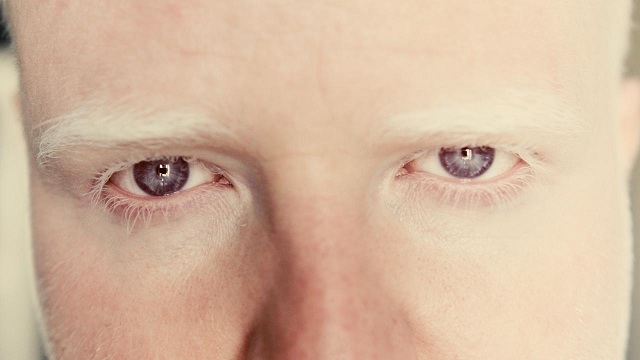 Albinismo, la  piel y los  ojos